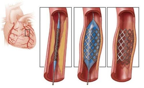 
Kỹ thuật nong mạch vành và đặt stent là kỹ thuật ít xâm lấn hơn so với phẫu thuật bắc cầu động mạch vành
