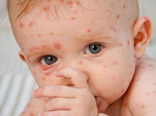 Chickenpox symptoms in babies