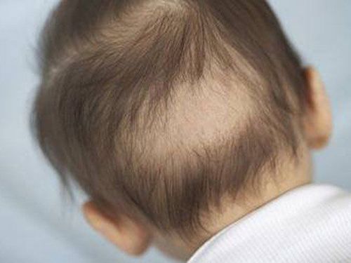 Is hair loss in children a cause for concern?