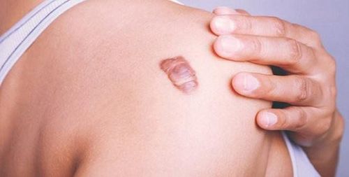 Injected at the site of the lesion effectively cures keloid scars