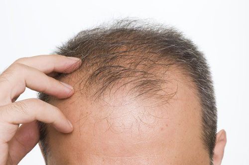 Hair loss in men: What you need to know