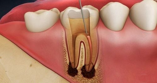 Các bước hàn ống tủy điều trị viêm tủy răng
