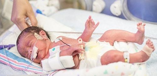 What is premature birth? 2 problems that premature babies often face and how to deal with them