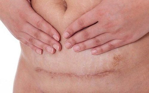 Getting pregnant too soon after a C-section increases the risk of uterine scar rupture.