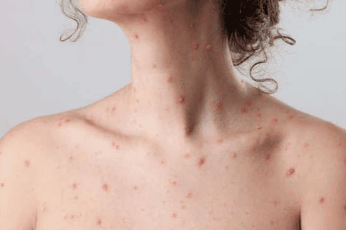 Can chickenpox come back?