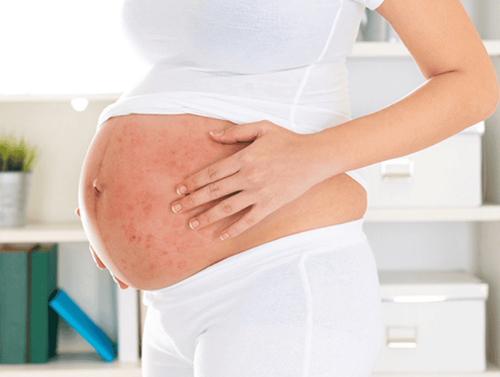 Dangerous complications of chickenpox in pregnant women