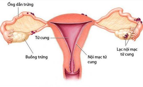 
Sau mổ có thể gặp phải biến chứng như lạc nội mạc tử cung
