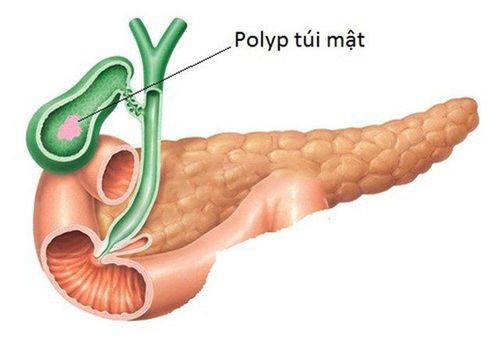 Đa polyp túi mật điều trị được không hay phải mổ?