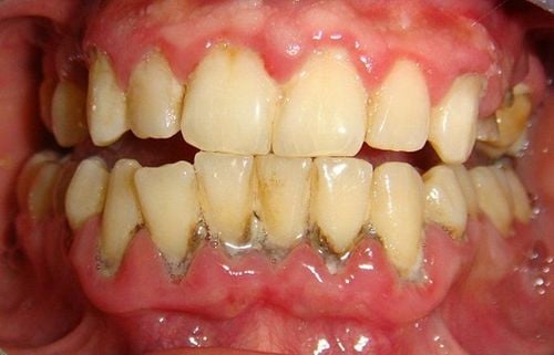 Bề mặt răng xuất hiện mảng bám đen dù được vệ sinh sạch sẽ, vì sao?