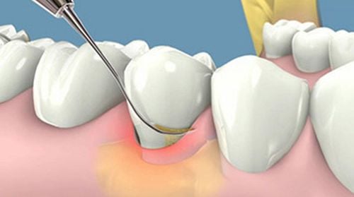 Harm of tartar (calcium)