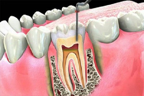 Treatment of pulpitis: When to take the whole pulp?