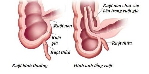 
Hình ảnh lồng ruột
