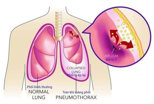 
Tràn khí màng phổi có thể là nguyên nhân gây đột tử ở người hen phế quản
