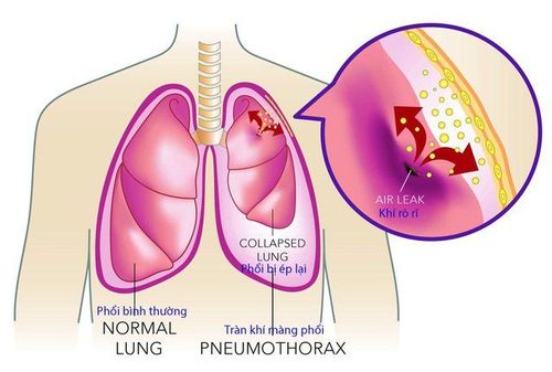 
Tràn khí màng phổi gây ra các cơn đau ngực ở một phía của ngực
