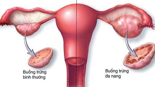 Diagnostic criteria for polycystic ovary