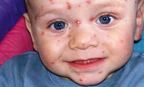 Chickenpox in infants: Signs and dangerous complications