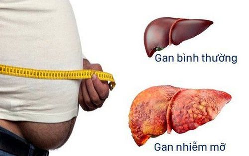 
Nhiều nghiên cứu đã chỉ ra tác động tích cực của việc giảm cân trong việc cải thiện gan nhiễm mỡ không do rượu.
