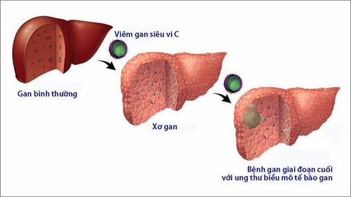 
Viêm gan C là một trong những bệnh truyền nhiễm về gan, nguy hiểm do virus Hepatitis C virus (HCV) gây nên
