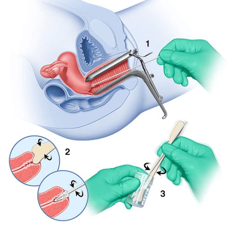 
Pap Smear là một xét nghiệm tế bào học để tầm soát phát hiện ung thư cổ tử cung ở phụ nữ
