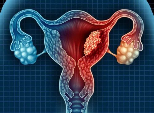 Complications of ovarian cysts