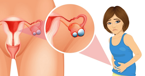 Signs of ovarian cysts are quite vague when there are no complications