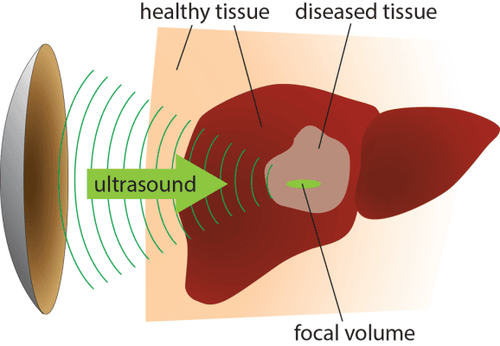 What is an elastography of the liver?