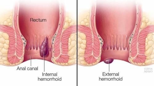 Hemorrhoids can be cured if detected and treated early