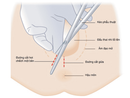 
Cắt tầng sinh môn của sản phụ khi sinh là một thủ thuật nhỏ của ngành sản khoa
