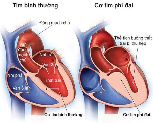 Bệnh cơ tim phì đại: Những điều cần biết