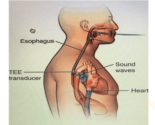 
Hình ảnh siêu âm tim qua thực quản
