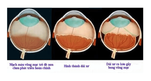 
Bệnh võng mạc trẻ đẻ non
