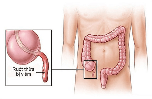 Chẩn đoán và điều trị viêm ruột thừa cấp