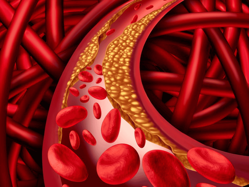 High blood lipids develop silently, determined by the following 4 test results