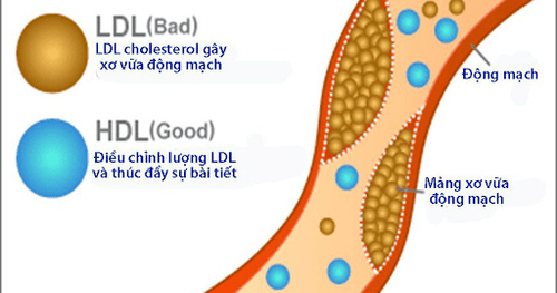 
HDL-cholesterol giảm là dấu hiệu cảnh báo mỡ máu cao
