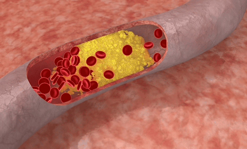 Treatment of high blood fat: What you need to know