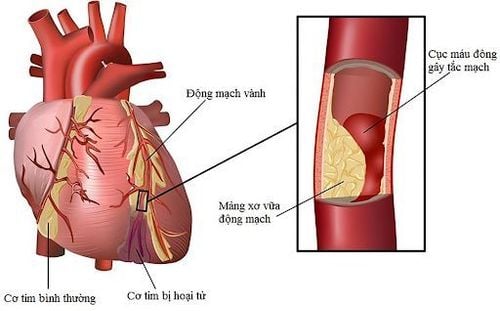 
Bệnh nhân rối loạn mỡ máu tăng nguy cơ mắc bệnh tim mạch chuyển hóa
