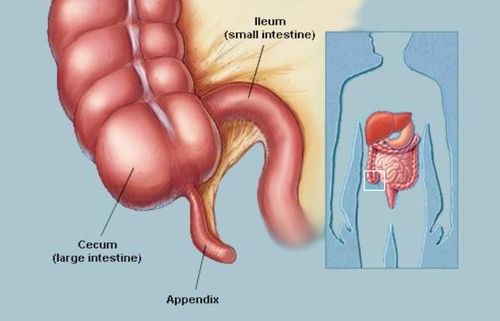 
Viêm ruột thừa cấp là bệnh cấp cứu ngoại khoa thường gặp
