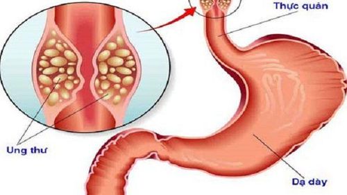 
Triệu chứng nuốt nghẹn tăng dần có thể dẫn tới nguy cơ ung thư thực quản
