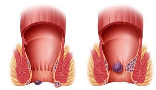 What is a hemorrhoid examination?