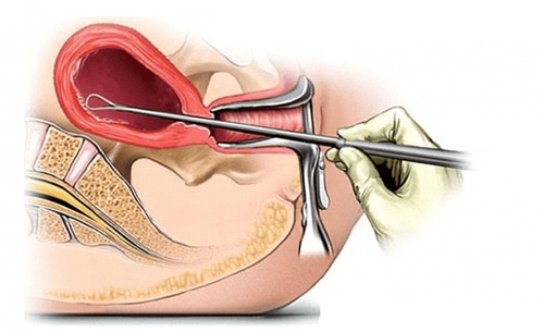 
Hút thai là một biện pháp phá thai được đánh giá là an toàn trong số những cách phá thai khác
