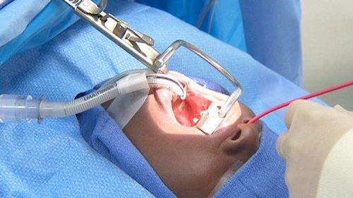 
There are many methods of cutting tonsils
