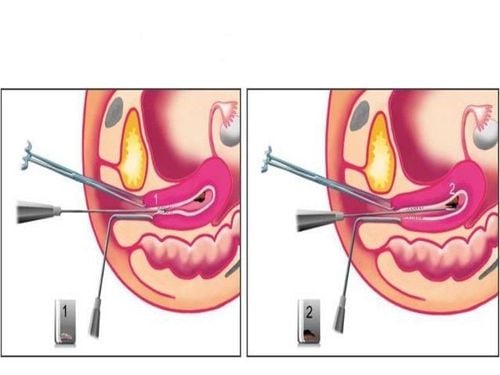 Uterine biopsy: What you need to know