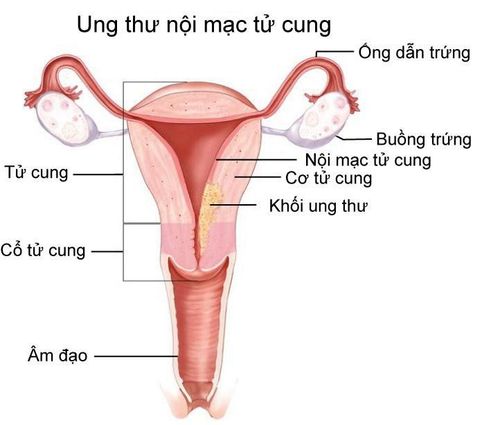 
Sinh thiết buồng tử cung giúp bác sĩ chẩn đoán các tổn thương bệnh lý ung thư nội mạc tử cung để điều trị sớm
