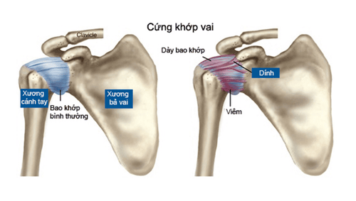 Tình trạng cứng khớp vai
