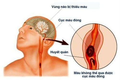 
Bệnh nhồi máu não gây nguy cơ cao về đột quỵ não
