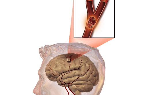 Brain infarction: What You Need to Know