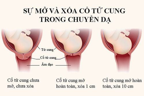 
Cổ tử cung bắt đầu giãn và mở: dấu hiệu này xuất hiện vài ngày
