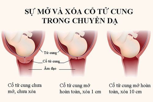 
Dấu hiệu chính xác của việc chuyển dạ giai đoạn thứ nhất
