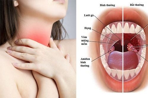 Tonsillitis in adults: Be careful with people over 45 years old