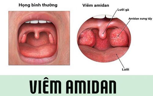 
Viêm amidan cấp tính là tình trạng viêm xung huyết và xuất tiết của amidan khẩu cái
